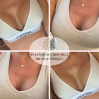 Instagram Post Brustvergrößerung bei Dr. med. B. Fouquet